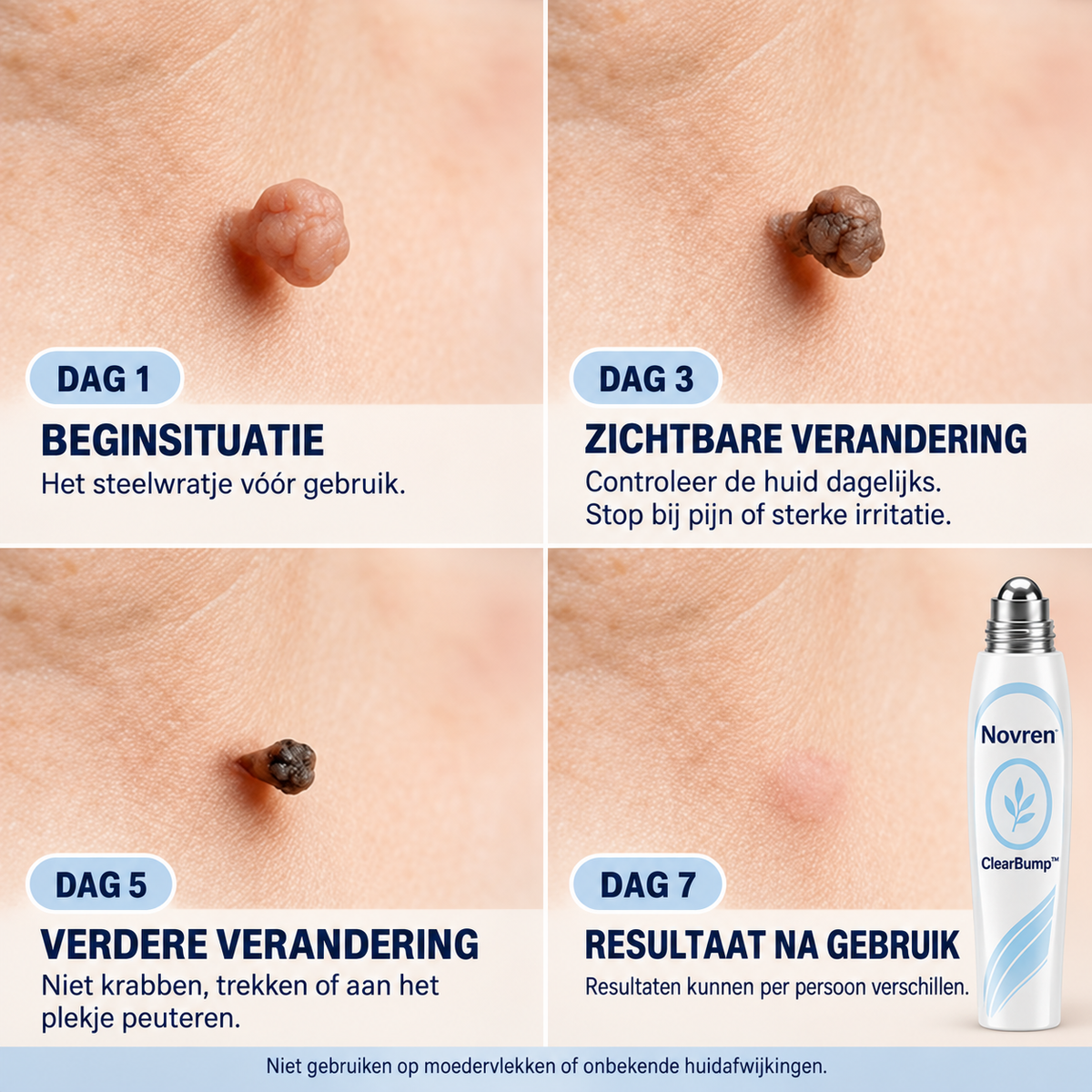 Novren ClearBump™ SkinRenew Verzorgingsroller 1+1 GRATIS