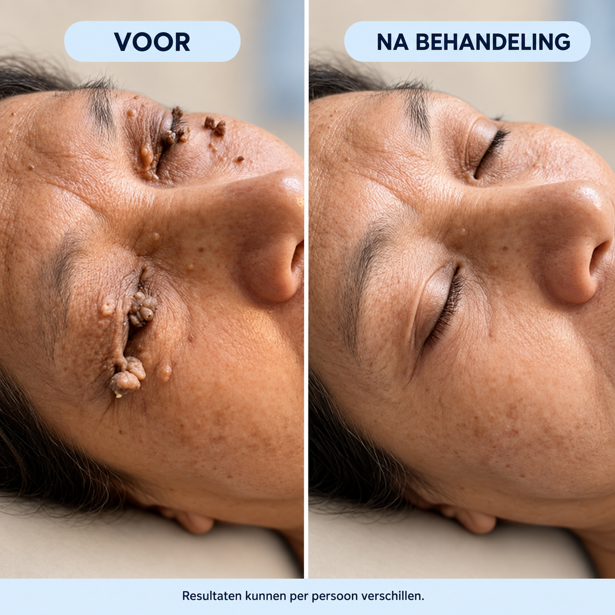 Novren ClearBump™ SkinRenew Verzorgingsroller 1+1 GRATIS